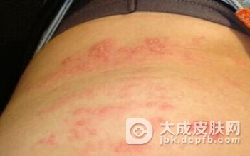 眼部皮肤过敏怎么治疗