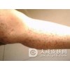 是因为什么导致了扁平苔藓发作
