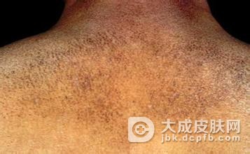 扁平苔藓怎么治疗效果好