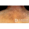 扁平苔藓怎么治疗效果好