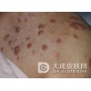 产生瘢痕疙瘩的原因有哪些