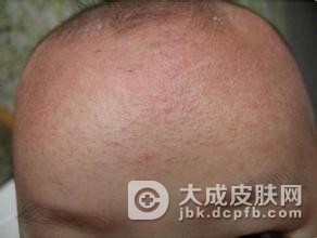正确饮食杜绝皮肤过敏现象