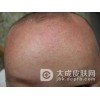 正确饮食杜绝皮肤过敏现象