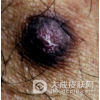 皮肤纤维瘤的发病机制介绍
