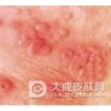 为什么梅毒有潜伏期