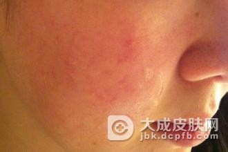 慢性食物过敏怎么回事