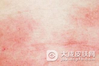 如何轻松攻防夏季皮炎