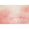 如何轻松攻防夏季皮炎