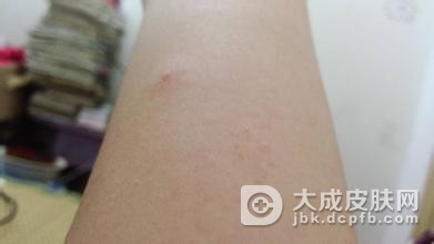夏季皮炎的措施有哪些