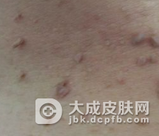 皮肤纤维瘤的发病原因