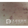 皮肤纤维瘤的发病原因