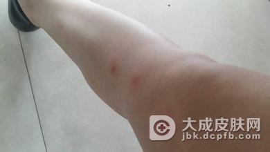 夏季抵制日光性皮炎的方法有哪些