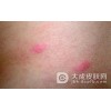 专家介绍单纯性疱疹病毒如何治疗