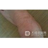 慢性湿疹为什么一直在反复的发作呢