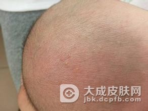 慢性湿疹的护理事宜有哪些