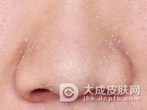 痘痘和粉刺是怎么产生的