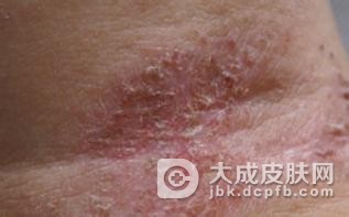皮肤瘙痒症食疗方法是什么