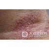 皮肤瘙痒症食疗方法是什么