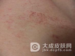 皮肤瘙痒起红疙瘩是什么病