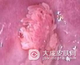 女性假性尖锐湿疣是一种什么样的疾病