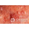 假性尖锐湿疣的临床特征