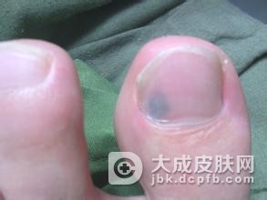 引发甲癣的四大主要原因
