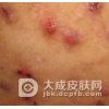 结节性痒疹的食疗方法