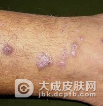 结节性痒疹不能吃什么呢