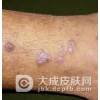 结节性痒疹不能吃什么呢