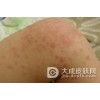 是什么引起了日光性皮炎