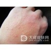 日光性皮炎要怎么治疗