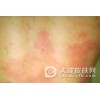 孩子日光性皮炎怎么护理?
