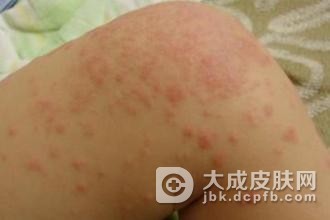 为什么女孩会得日光性皮炎呢