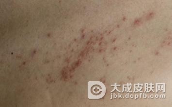 蔬菜也会引起日光性皮炎吗?