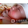 孩子得了日光性皮炎应该怎样护理