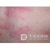 什么是色素性荨麻疹?