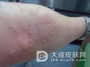 色素性荨麻疹的病因和症状