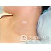 白癜风早期的症状是怎样的