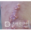 黄瘤病怎样治疗较好