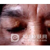 黄瘤病有哪些治疗的方法
