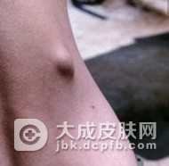 如何治疗黄瘤病才好