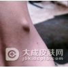 如何治疗黄瘤病才好