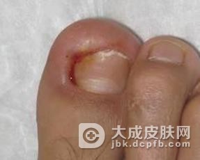 甲沟炎该如何预防
