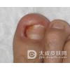 甲沟炎该如何预防