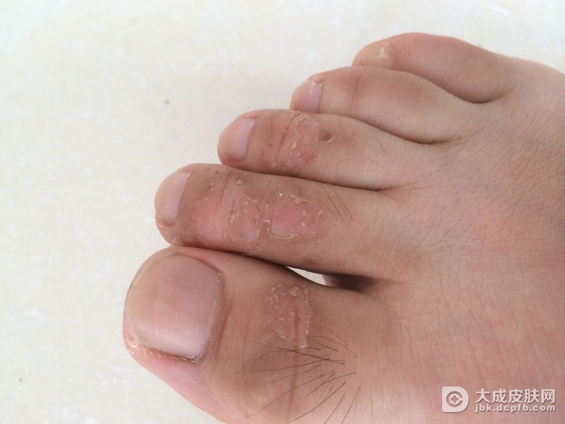 皮肤瘙痒的常见病因包括什么呢