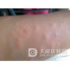 皮肤瘙痒的具体症状都有哪些呢