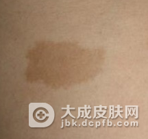 小儿患有咖啡斑该怎么办