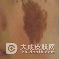 激光会去掉咖啡斑吗