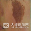 激光会去掉咖啡斑吗