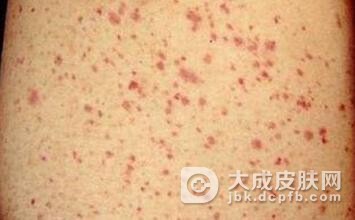 得了阴虱病该怎么正确治疗呢